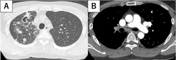 A Case of Nontuberculous Mycobacterial Pulmonary Disease Complicating Massive Pulmonary Embolism.