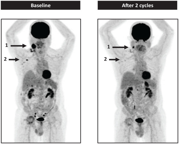 Notch pathway inhibition with crenigacestat (LY3039478) in a phase I first-in-human clinical trial for patients with relapsed or refractory non-Hodgkin lymphoma and B-cell chronic lymphocytic leukemia.