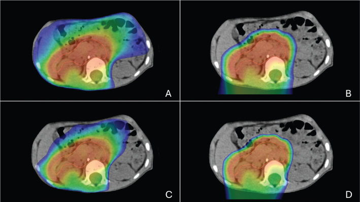 Comparative proton and photon treatment plans in children treated for neuroblastoma.