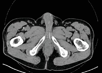 Erectile Dysfunction and Peyronie's Disease Following a Severe Case of COVID-19: A Case Report.