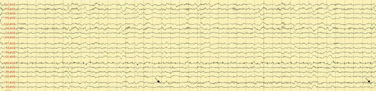 Tuberculous meningitis initially presented with low levels of pleocytosis and protein in the cerebrospinal fluid: a case report.