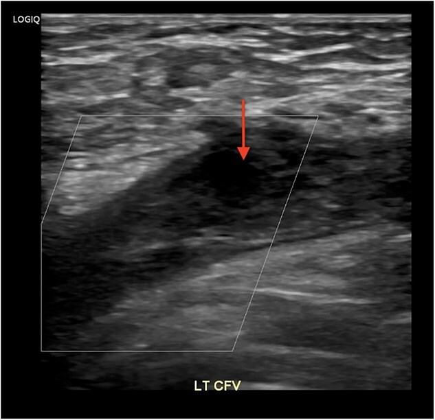 Case report: may-Thurner syndrome: early diagnosis and intervention in a young healthy woman.