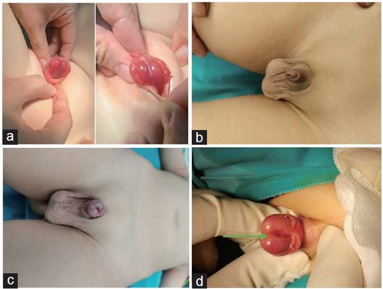 Comparative analysis of isolated male epispadias: concealed versus nonconcealed cases in a Chinese tertiary hospital.