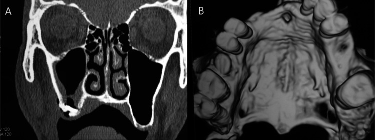 Clinical and radiographic evaluation of the efficacy of vital- os bone cement in stabilizing an autogenous monocortical bone graft in the repair of oroantral fistula (a comparative study).