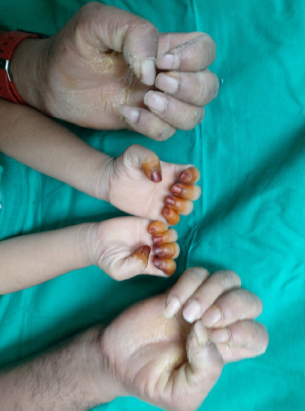 A case report of palmoplantar keratoderma in a 3-year-old girl: A structured approach in primary care settings.
