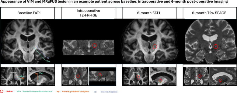 FAT1-weighted MRI-guided focused ultrasound thalamotomy for essential tremor.