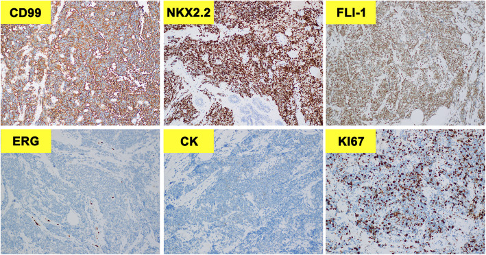 Extra-skeletal Ewing's sarcoma with EWSR1::ERG translocation of the breast: a case report.