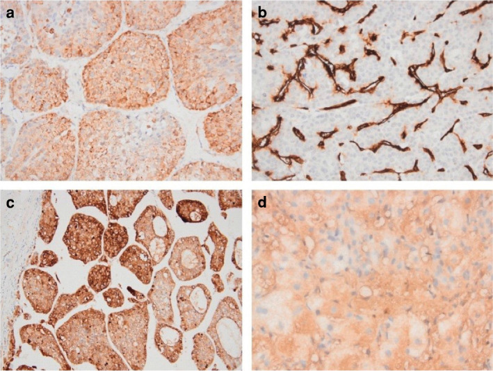 Predicting hepatocellular carcinoma development in advanced fibrosis or cirrhosis due to chronic hepatitis B: The role of glypican-3, heat shock protein 70, CD34, and glutamine synthetase.