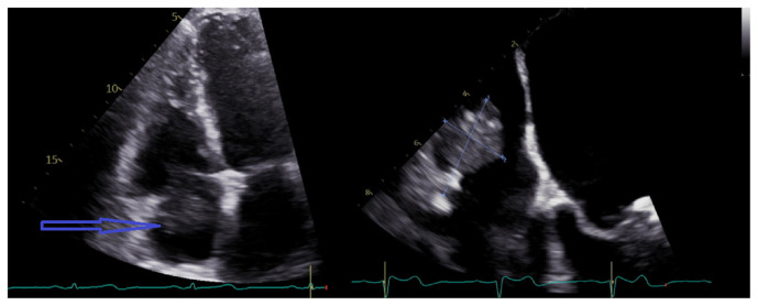 Intradialytic Atrial Fibrillation With Rapid Ventricular Response From Catheter-related Right Atrial Thrombus.