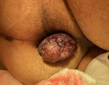 Cytokine Release Syndrome Induced by Pembrolizumab for Metastatic Anal Melanoma.