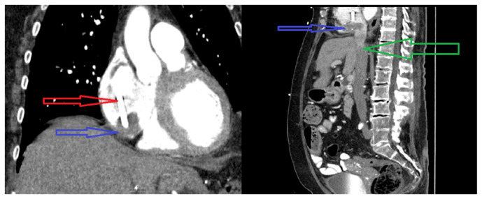 Intradialytic Atrial Fibrillation With Rapid Ventricular Response From Catheter-related Right Atrial Thrombus.