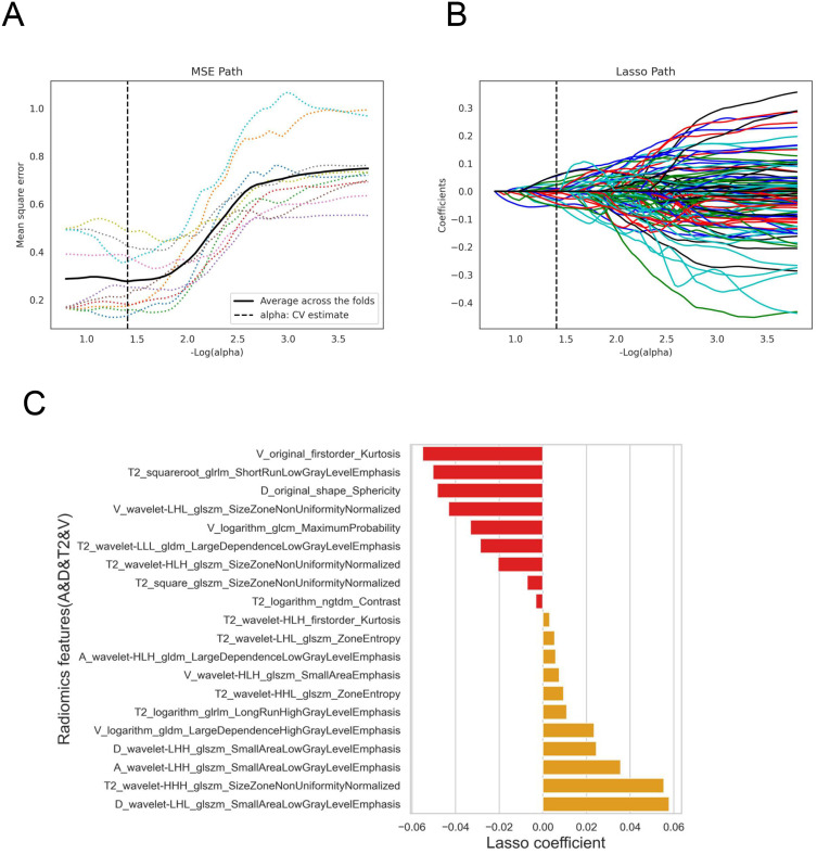Development and Validation of a Radiomics Nomogram Based on Magnetic Resonance Imaging and Clinicoradiological Factors to Predict HCC TACE Refractoriness.
