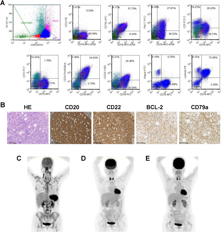 Novel Loop-Structure-Based CD19/CD22 Dual-Target CAR-T Therapy for High-Risk Diffuse Large B-Cell Lymphoma Presenting with Hemophagocytic Lymphohistiocytosis: A Case Report.