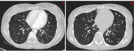 <i>Mycobacterium abscessus</i> Pulmonary Disease in a Myasthenia Gravis Patient: A Case Report.