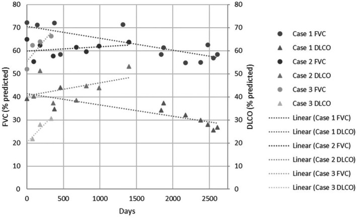 <i>ABCA3</i> Surfactant-Related Gene Variant Associated Interstitial Lung Disease in Adults: A Case Series and Review of the Literature.