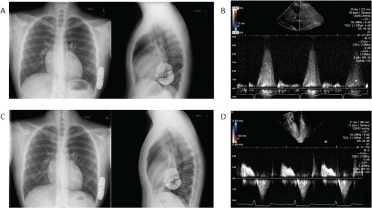 Preserved Subcutaneous Implantable Cardioverter-defibrillator Function Following Septal Myectomy and Coronary Artery Unroofing in a Pediatric Patient with Severe Hypertrophic Cardiomyopathy.