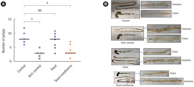 Impact of stool transplantation and metformin on polyp reduction and inflammation in an APC Min mouse model.