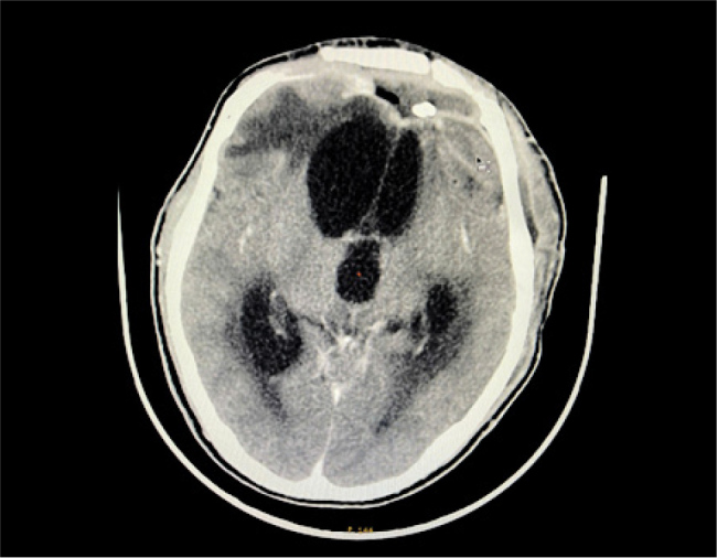 Continuous Irrigation for Refractory Multidrug-Resistant Brain Abscess in two Patients.