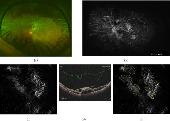 Correlation Between Postoperative Vitreous Hemorrhage and Preoperative Evaluation of Optical Coherence Tomography Angiography in Proliferative Diabetic Retinopathy Surgery.