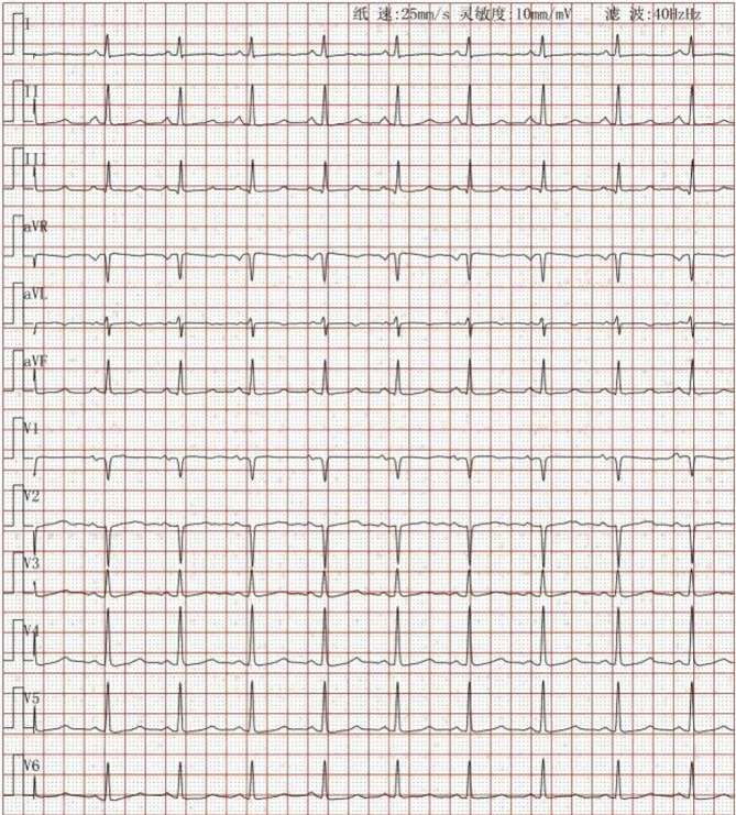 A case of hypoparathyroidism with cardiovascular complications: interventricular septal dissecting aneurysm in a middle-aged woman.