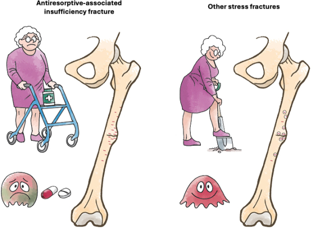 Perspective: The misleading label of atypical femur fracture: a call for diagnostic clarity amid biological diversity.