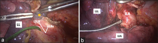 Prevention of intraoperative bleeding during thoracoscopic left lower lobectomy; an unnecessary occlusion of pulmonary artery and vein.