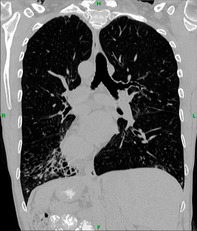 Management of Primary Ciliary Dyskinesia in a Kartagener's Syndrome Patient With Total Situs Inversus.