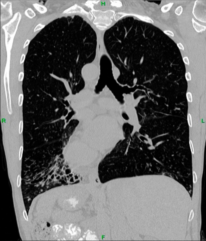 Management of Primary Ciliary Dyskinesia in a Kartagener's Syndrome Patient With Total Situs Inversus.