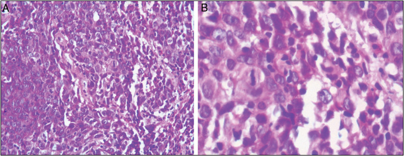Premalignant and Malignant Ocular Surface Squamous Cell Neoplasia: A Retrospective Hospital-Based Study Spanning 18 Years.