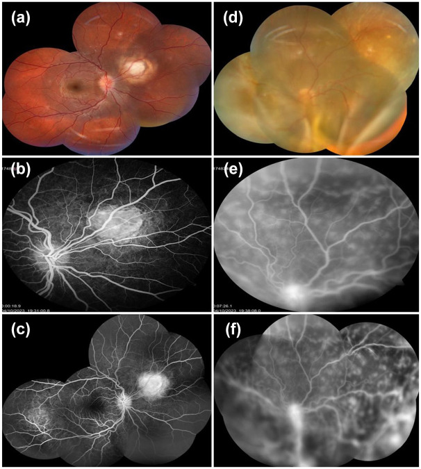 Bilateral intraocular masses in a child as a first presentation of disseminated tuberculosis: case report.
