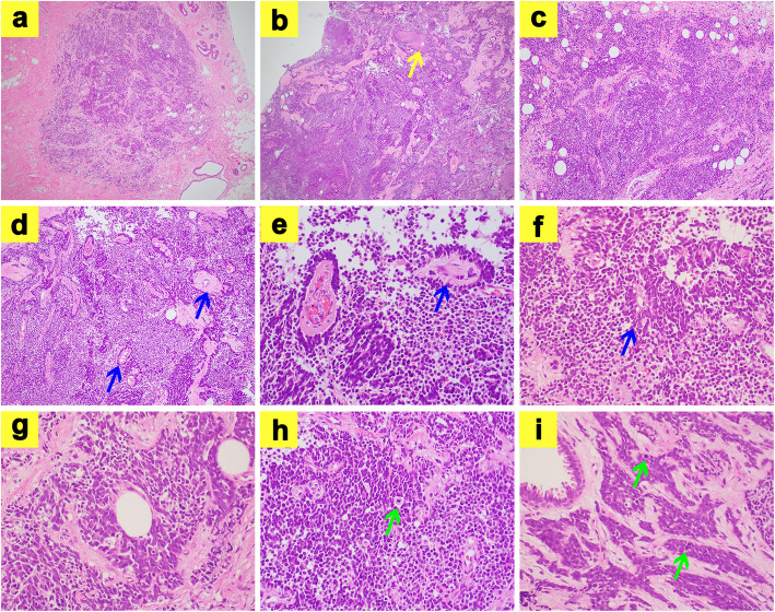 Extra-skeletal Ewing's sarcoma with EWSR1::ERG translocation of the breast: a case report.