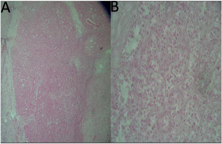 Giant Infarcted Lactating Adenoma Mimicking Inflammatory Breast Carcinoma: A First Case Report from Somalia.