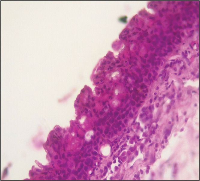 Premalignant and Malignant Ocular Surface Squamous Cell Neoplasia: A Retrospective Hospital-Based Study Spanning 18 Years.