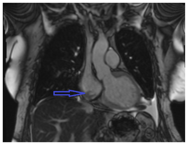 Intradialytic Atrial Fibrillation With Rapid Ventricular Response From Catheter-related Right Atrial Thrombus.