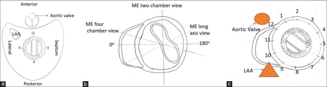 Schematic Clock Diagram to Assess Mitral Paravalvular Leak by 2D TEE.