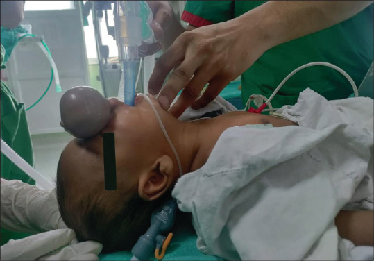 Unmasking success: Airway management in a case of nasal teratoma.