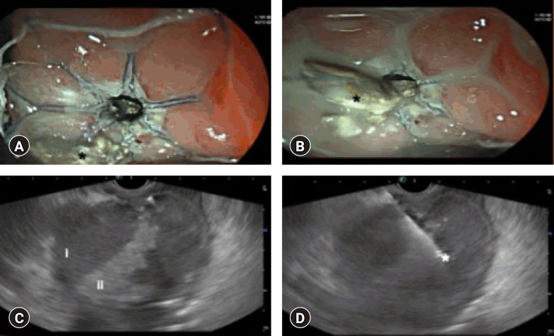 Exploring lumen-apposing metal stents as a novel approach for managing walled-off necrosis in pediatric acute pancreatitis in Indian cohort: a prospective study.