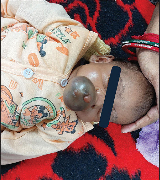 Unmasking success: Airway management in a case of nasal teratoma.
