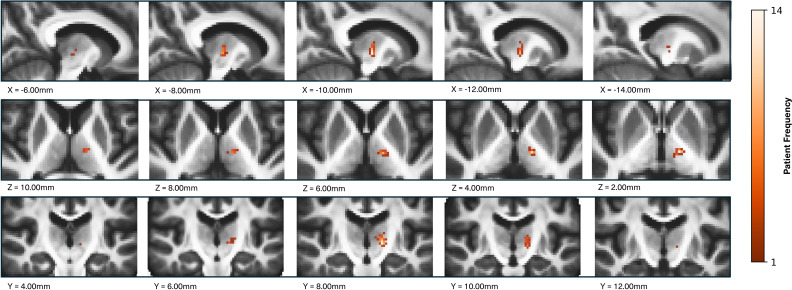 FAT1-weighted MRI-guided focused ultrasound thalamotomy for essential tremor.