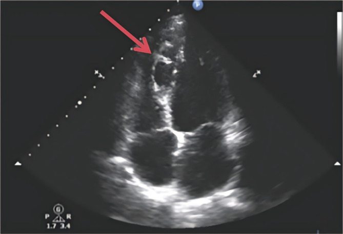 A case of hypoparathyroidism with cardiovascular complications: interventricular septal dissecting aneurysm in a middle-aged woman.