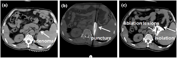 Kangbo Knife Cryoablation for the Treatment of Functional Adrenal Tumors.