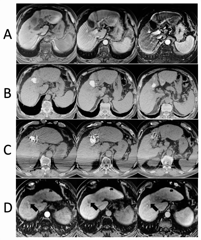 Investigation into the efficiency and prognostic elements of CT-guided ¹²⁵I particle implantation for liver cancer.