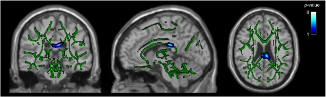 White matter tract differences in persistent post-traumatic headache, migraine, and healthy controls: a diffusion tensor imaging study.