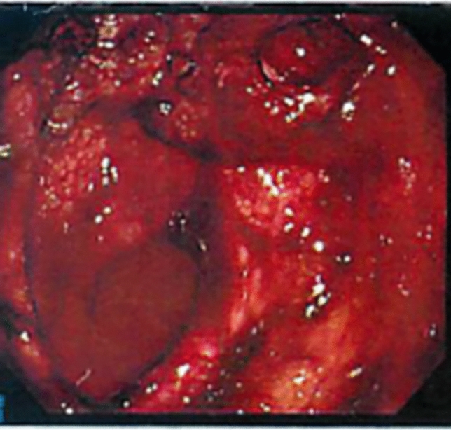 Early angiographic changes after hemostatic radiotherapy for gastric cancer bleeding, mentioning the mechanism and potential immediate effects of the treatment.