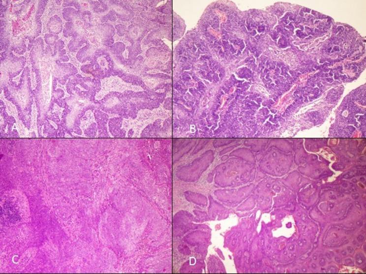 Clinicopathological features and reclassification of penile squamous cell carcinoma according to WHO classification 2022 for penile carcinoma with p16 immunohistochemical expression and its prognostic impact.
