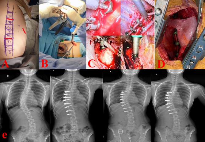 The role of thoracic surgeons in spinal surgery: our clinical experiences.