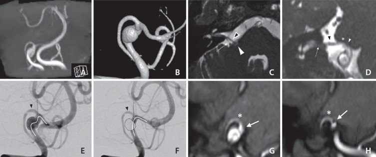 Hemifacial Spasm Caused by Posterior Inferior Cerebellar Artery Compression due to Vertebral Artery Aneurysm: Management with Stent-Assisted Coil Embolization.