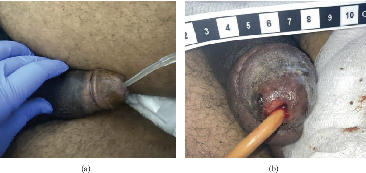A Case of Malignant Priapism Secondary to Muscle Invasive Bladder Cancer and Review of Palliative Management.