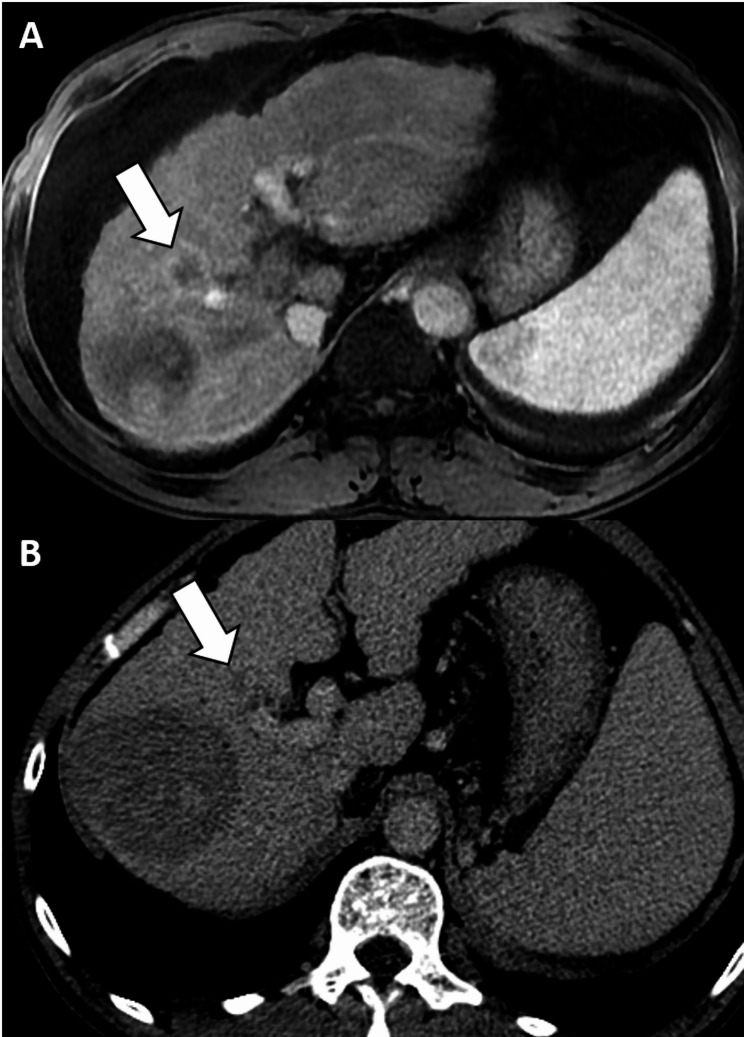 Value of threshold growth for the diagnosis of hepatocellular carcinoma using LI-RADS.