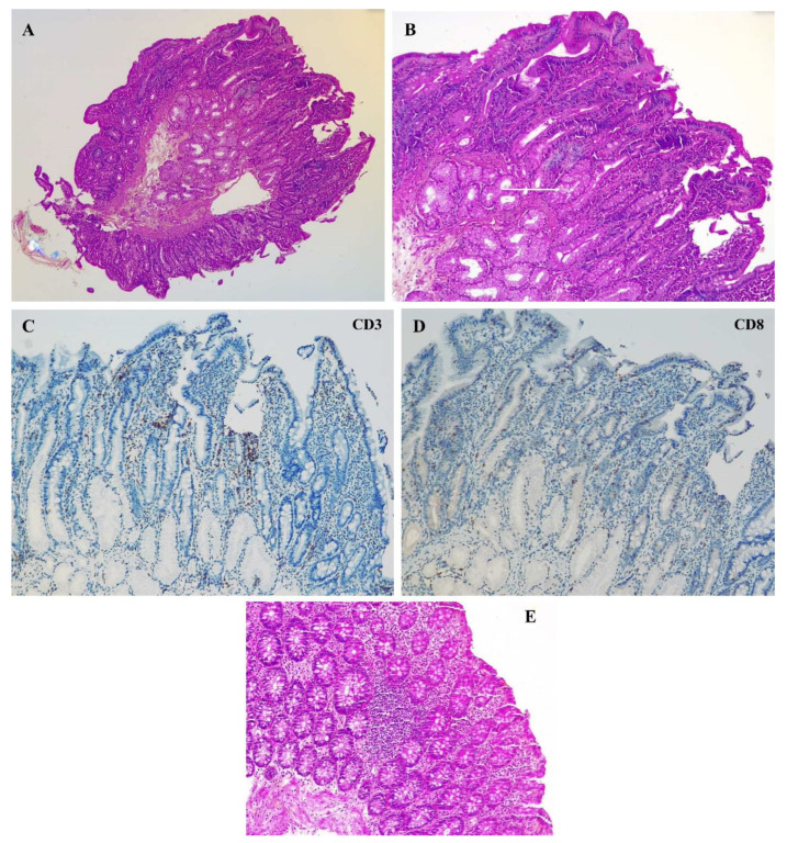 Atypical Rapid Onset of Olmesartan-Induced Enteropathy with Recurrence After Rechallenging.